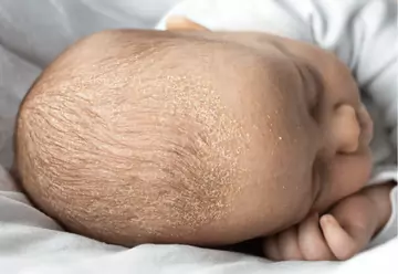 Молочные корочки